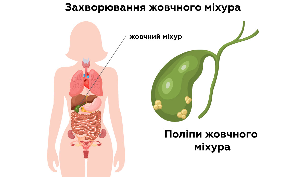 захворювання жовчного міхура