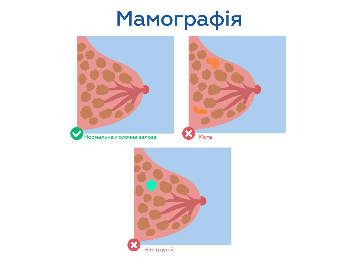 здорова грудна залоза; з кістою; з пухлинним утворенням