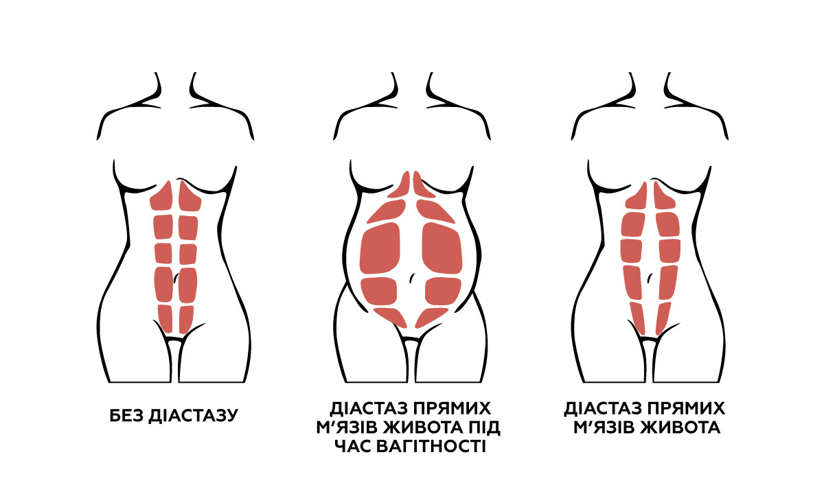 зображення того, як вигладає діастаз після вагітності