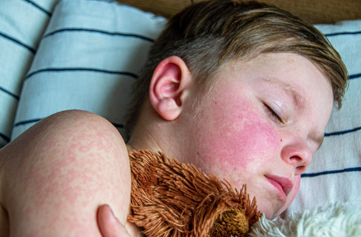 Що таке скарлатина. Симптоми скарлатини та як вона виглядає