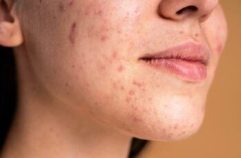 обличчя з запаленням шкіри у вигляді висипів