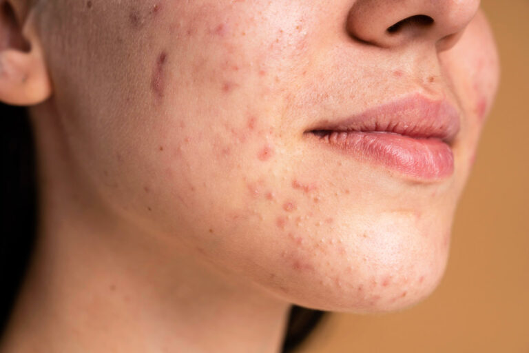 Що таке демодекоз: як проявляється у людини та як лікувати