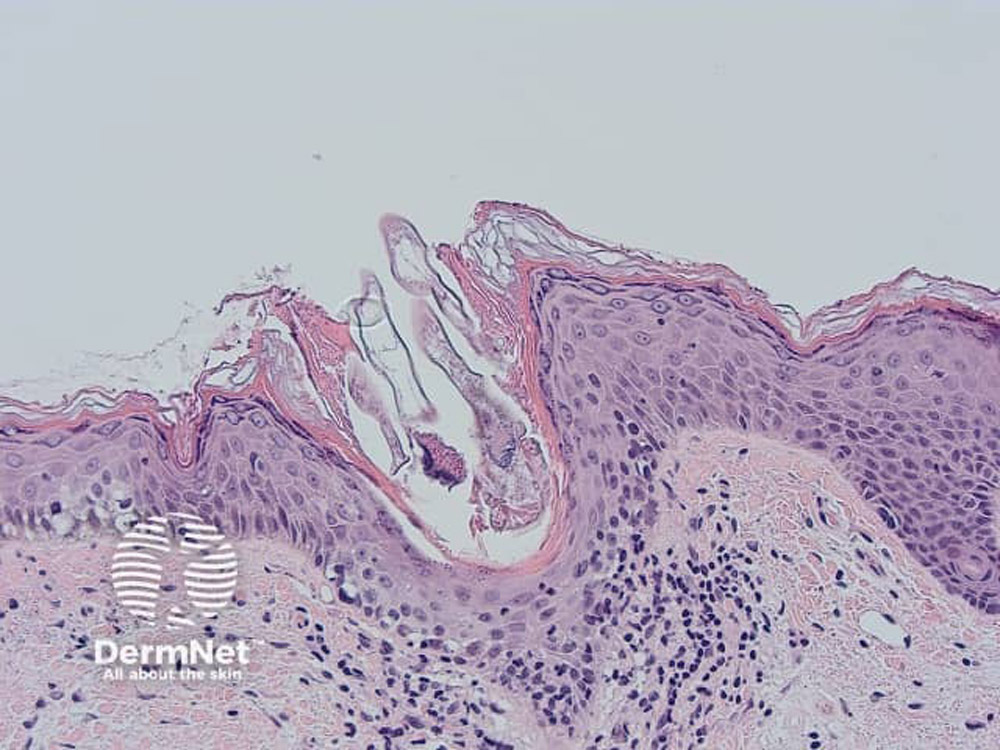 вигляд шкіри з демодексом під мікроскопом