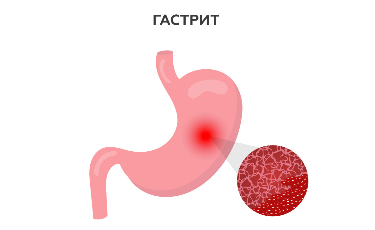 Автоімунний атрофічний гастрит