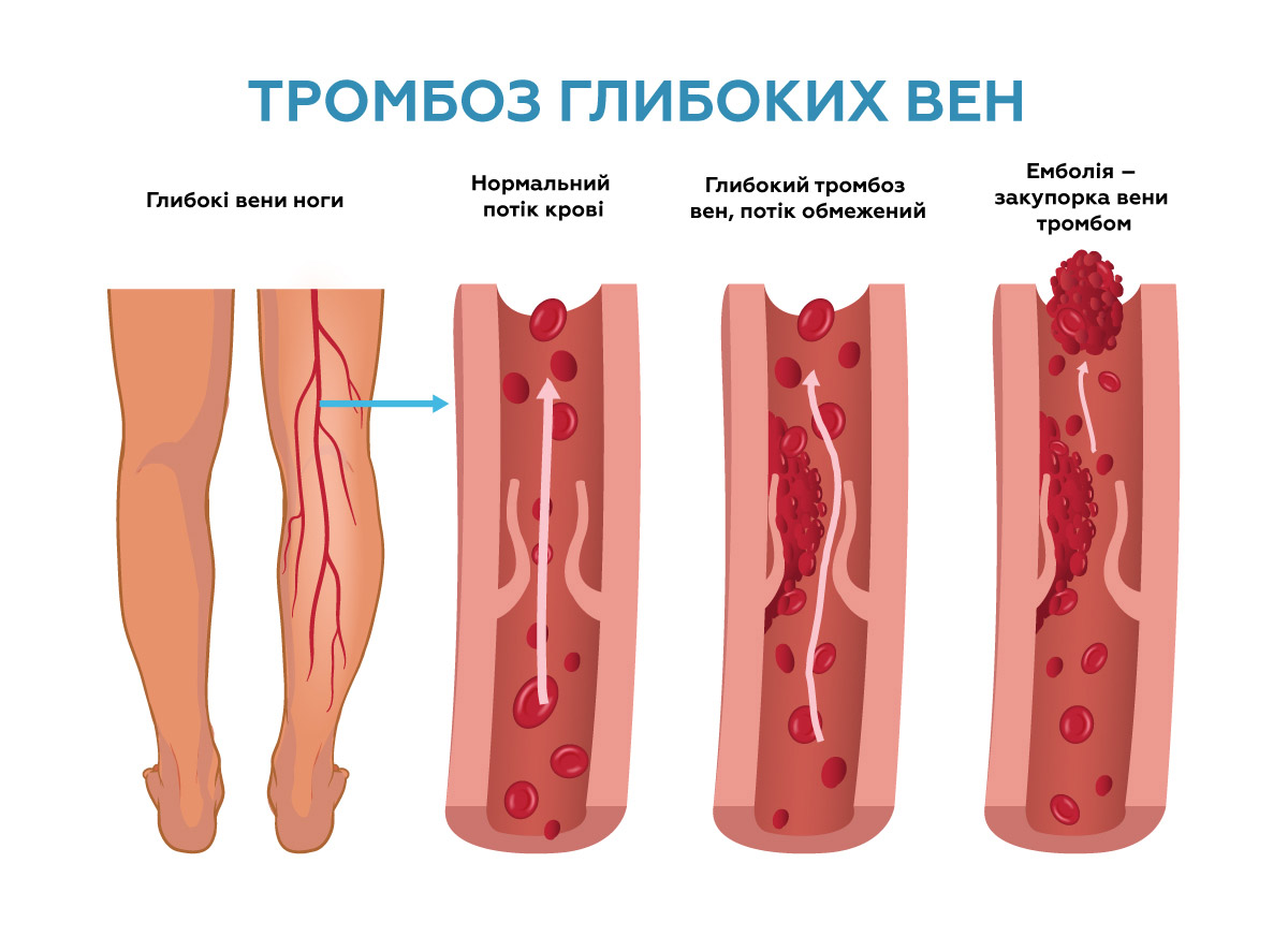 Чим небезпечна густа кров. Наслідки та ризики