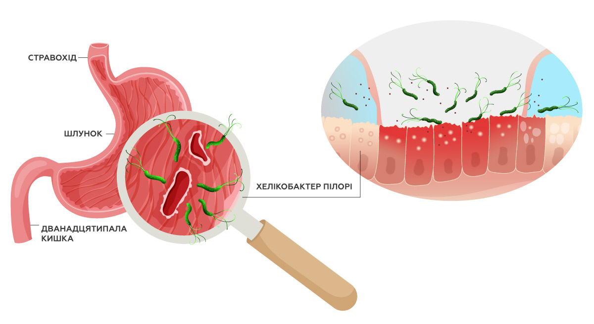 Хронічне запалення та вплив Helicobacter pylori