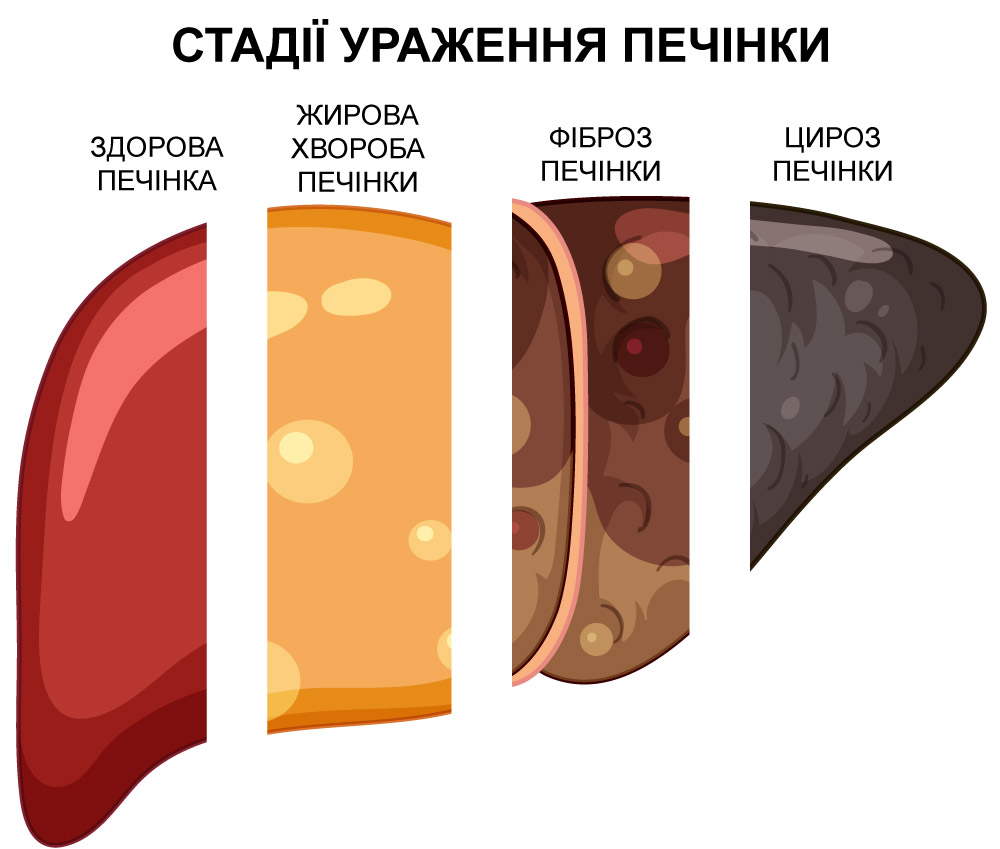 Хвороби печінки у людини. Від гепатиту до цирозу