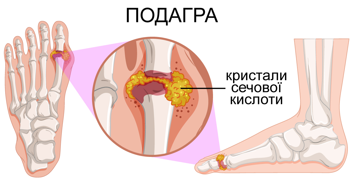 Подагра на нозі ураження суглоба великого пальця