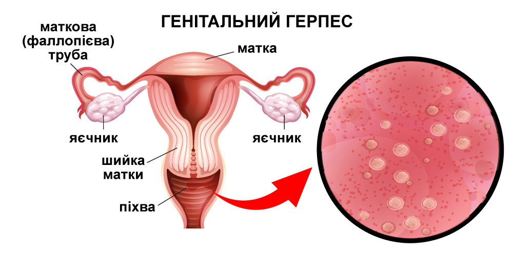 Що таке генітальний герпес та особливості вірусу (ВПГ)