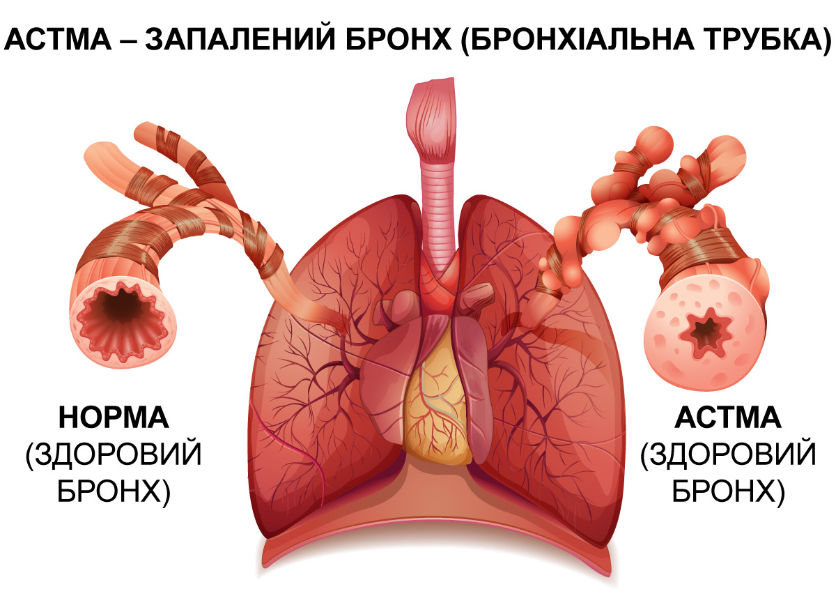 Як працюють бронхи і чому виникає спазм
