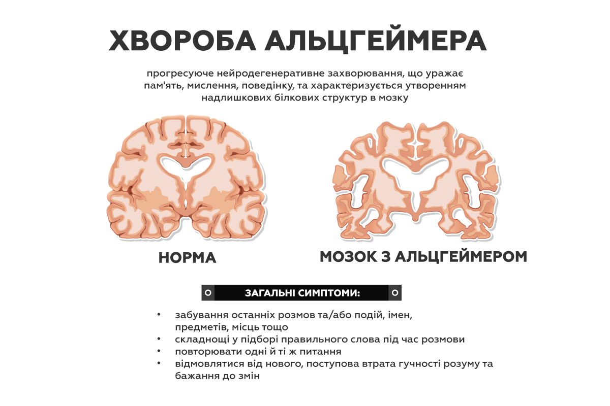 Що таке Альцгеймер