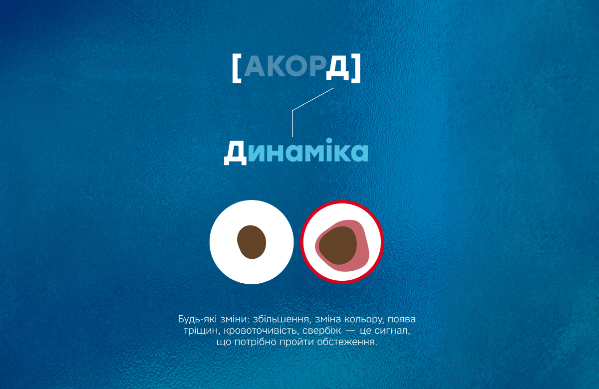правило АКОРД &ndash; коли потрібна дерматоскопія