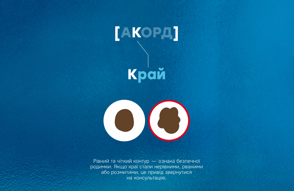 правило АКОРД &ndash; які бувають родимки