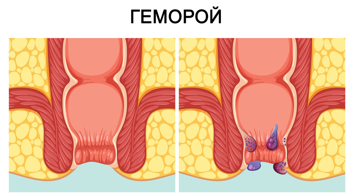 Причини появи гемороїдальних вузлів