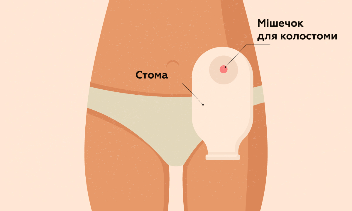 Як доглядати за стомою в домашніх умовах